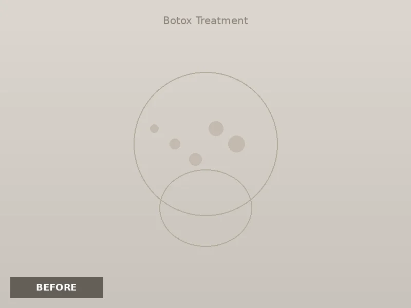 Anti-Aging Filler before and after