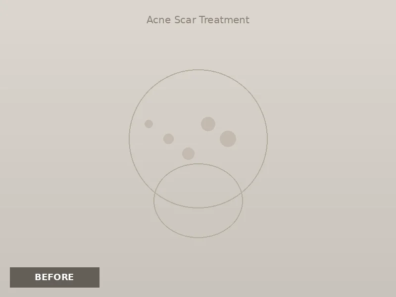 Acne Scar Treatment before and after